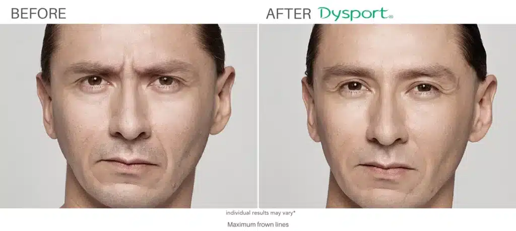 Dysport Before and After 1.png Dysport Before and After 1.png