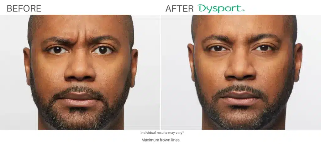 Dysport Before and After 2.png Dysport Before and After 2.png