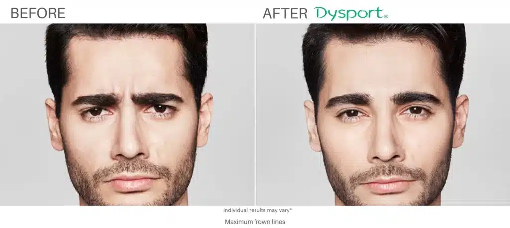 Dysport Before and After 3.png Dysport Before and After 3.png
