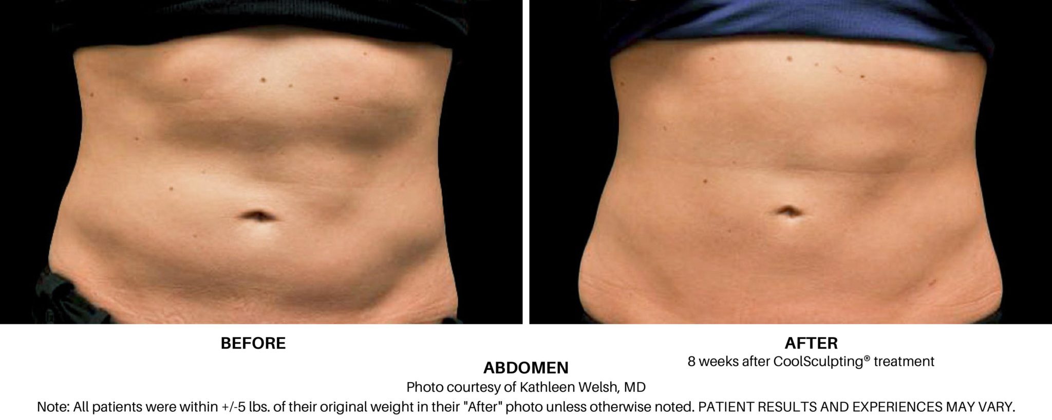 CoolSculpting for Bra and Upper Back Fat - Contour Dermatology