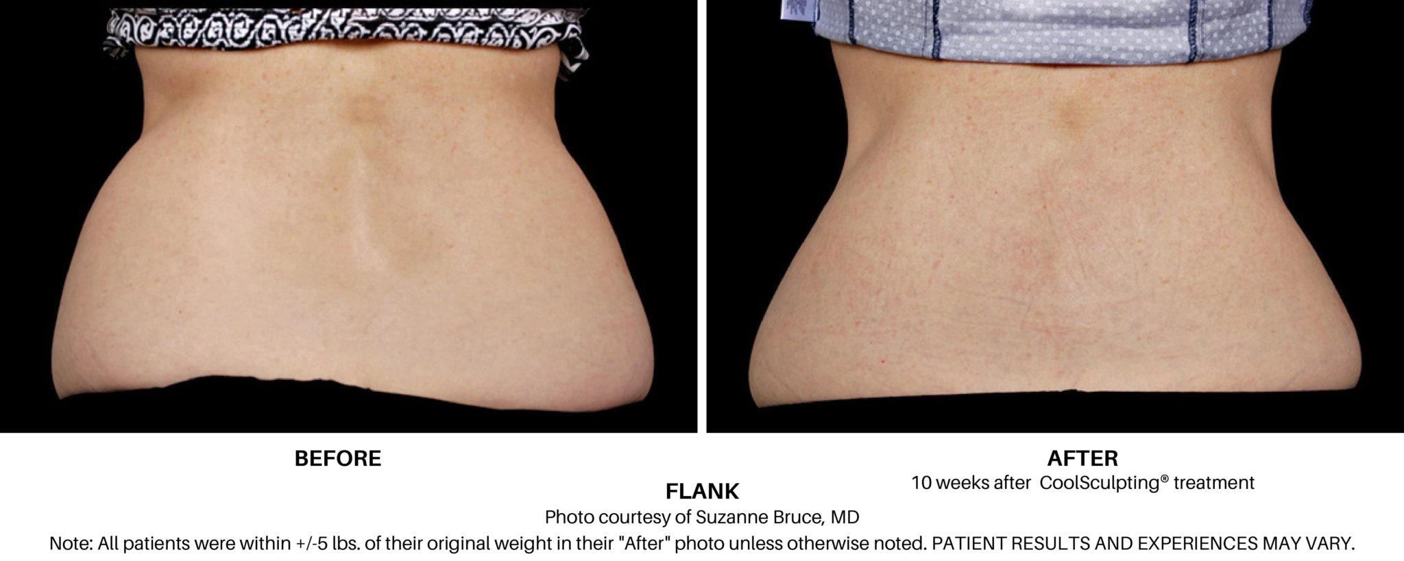 Excessive flank fat - too big flanks